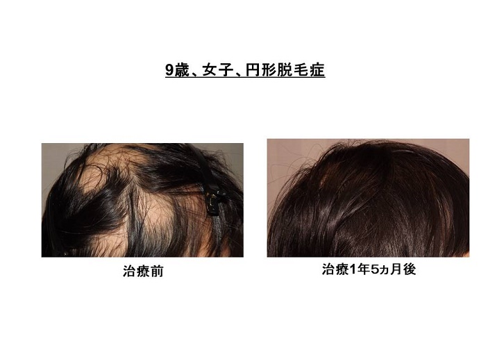 円形脱毛症　病院""
